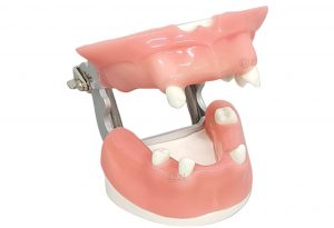 Partial Edentulous Dental Model with Gingiva and Metal Hinge