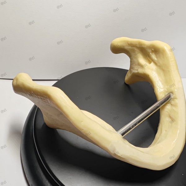 Mandible Implant Model with Metal Guide Rod Dental mandibular implant training model equipped with a metal guide rod for implant positioning and surgical guide creation practice