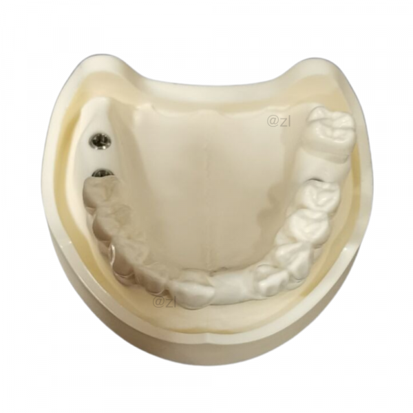 Upper Jaw Model with Dual Implant Screws Inserted