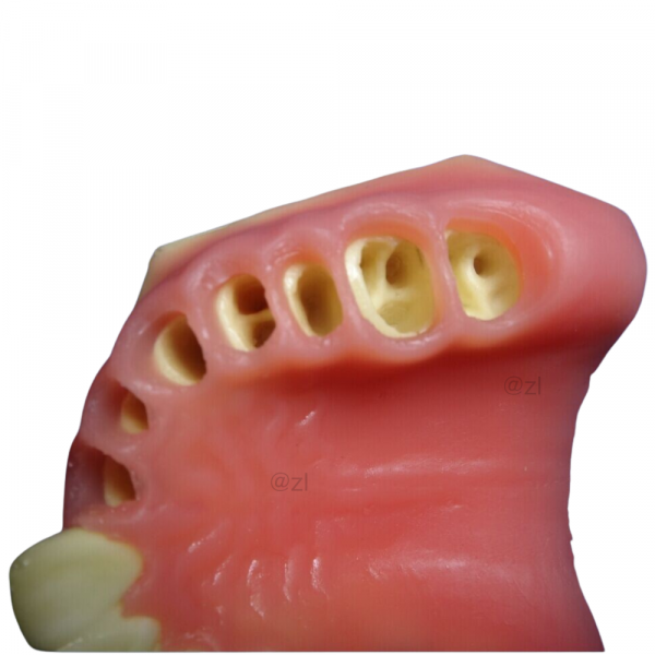 Close-up of gingival tissue with multiple implant sockets for upper arch