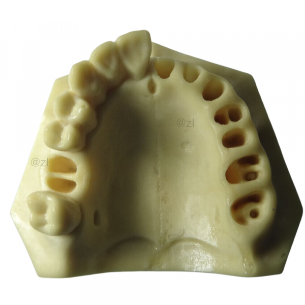 Upper jaw dental model with open implant sockets and prepared teeth