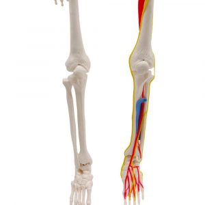 comparison of normal arm bones and arm with vessels