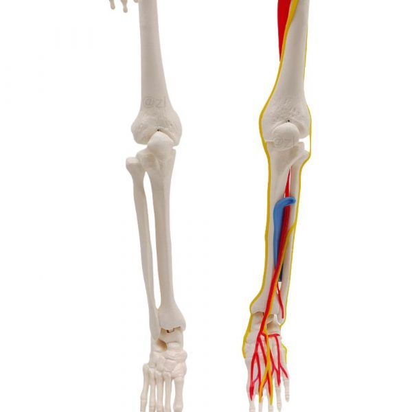 comparison of normal arm bones and arm with vessels