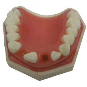 Top view of maxillary dental implant training model with missing tooth socket