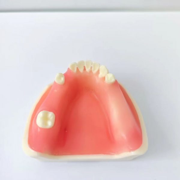 Upper jaw dental model with soft pink gingiva and partially missing teeth