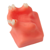 Left-side view of implant training jaw model with simulated molars