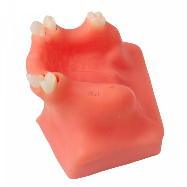 Left-side view of implant training jaw model with simulated molars
