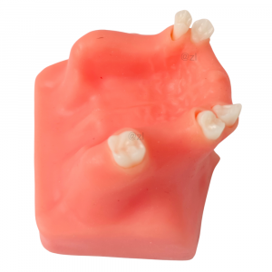 Top-view upper jaw dental model with edentulous molar sites