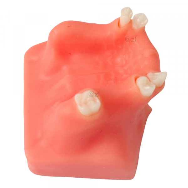 Top-view upper jaw dental model with edentulous molar sites