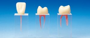 Hot Sale Dental Root Canal Crown Treatment S3