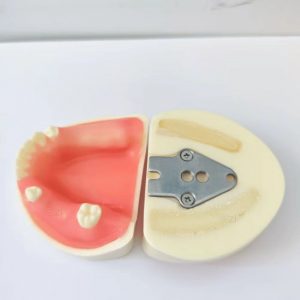 Dental implant model front and back view with screw-mount base