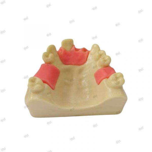 Upper Jaw Dental Model Showing Bone Ridge and Gum Simulation
