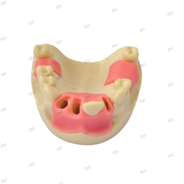 Front view of upper jaw dental model showcasing open implant sockets and soft gum simulation