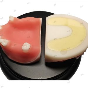 Upper Jaw Implant Model Front and Back View with Soft Gum and Resin Base
