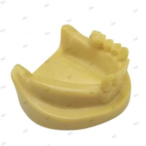 Lower jaw partial edentulous dental implant model