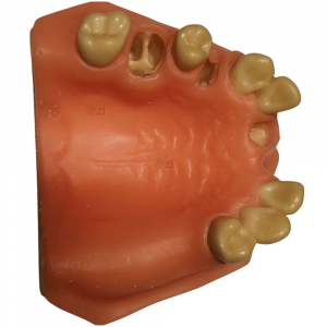 Maxillary dental model showing partial edentulous area and pre-drilled implant holes for surgical training