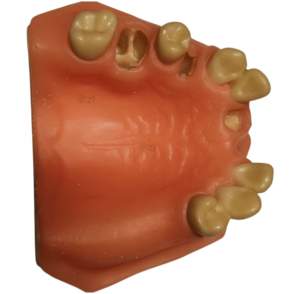 Maxillary dental model showing partial edentulous area and pre-drilled implant holes for surgical training