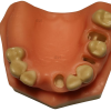 Upper jaw dental model with soft gingiva and clear implant preparation sites for training purposes