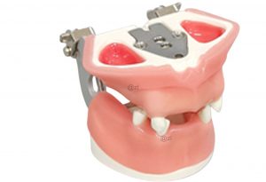 Dental Jaw Model Showing Implant Base and Gingival Tissue