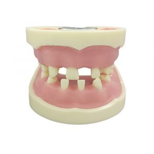 Dental Implant Practice Model – Realistic Missing Teeth Structure Dental implant training model with missing teeth and realistic gums for oral surgery practice