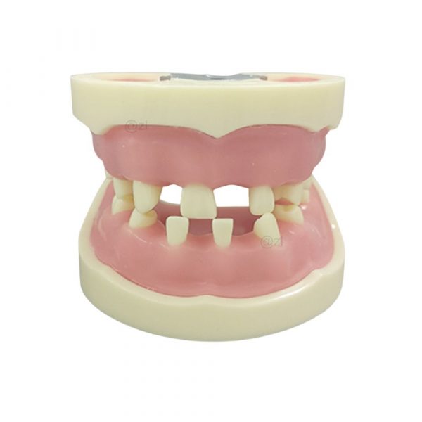 Dental Implant Practice Model – Realistic Missing Teeth Structure Dental implant training model with missing teeth and realistic gums for oral surgery practice