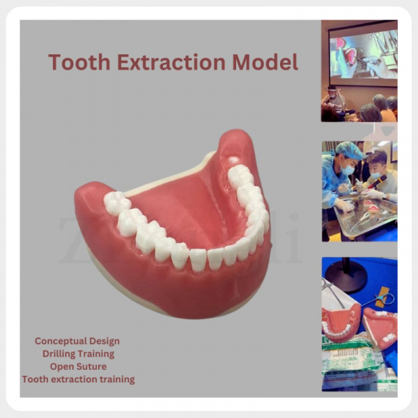 Impacted Tooth Extraction Training Model with Gingival Inflammation Simulation