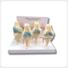 4 Stages Knee Joint Model Front View for Osteoarthritis Teaching 4 stages knee joint model showing osteoarthritis progression front view for medical teaching