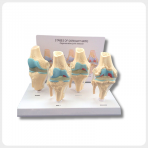 4 stages knee joint model showing osteoarthritis progression front view for medical teaching