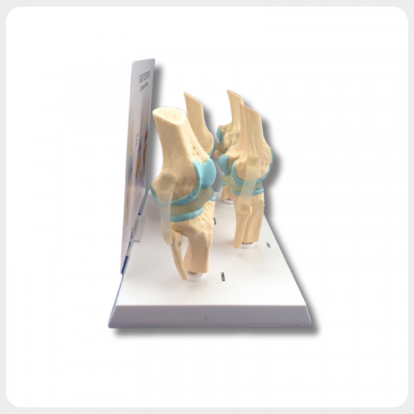 Side View Knee Joint Model Osteoarthritis Stages side view of knee joint model showing osteoarthritis stages for medical training