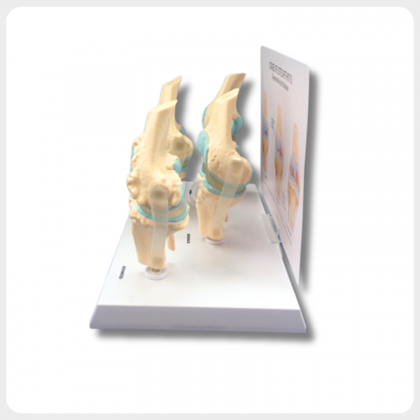 Rear View Knee Joint Model for Osteoarthritis Demonstration rear view knee joint model osteoarthritis progression for medical education