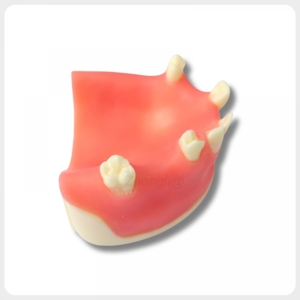 Dental Implant Training Model with Soft Tissue Upper Jaw dental implant training model with soft tissue and multiple missing teeth upper jaw