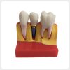 4X Dental Implant Demonstration Model for Clinics 4x dental implant demonstration model for clinic patient communication