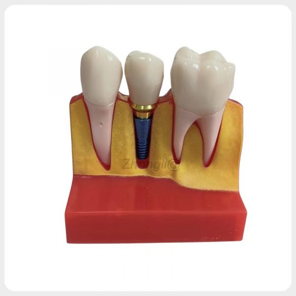 4X Dental Implant Demonstration Model for Clinics 4x dental implant demonstration model for clinic patient communication