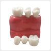 Dental Implant Model Back View with Gum Simulation dental implant model back view showing gum and tooth structure