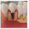 Dental Implant Model Structure with Crown and Abutment (1) dental implant demonstration model showing implant abutment and crown structure