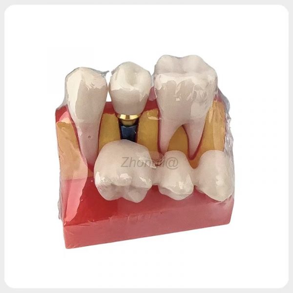 Dental Implant Restoration Demonstration Model dental implant model showing crown placement and implant restoration result