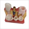 Removable Crown Dental Implant Demonstration Model dental implant model with removable crown showing implant components