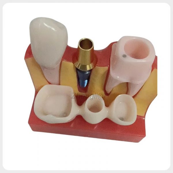 Removable Crown Dental Implant Demonstration Model dental implant model with removable crown showing implant components