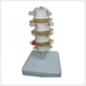4-section lumbar spine model with nerves and herniated disc