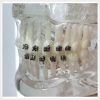 Dental orthodontic model with metal brackets for orthodontic training and bracket comparison