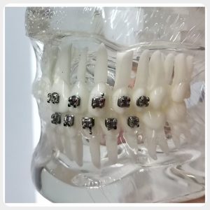 Dental orthodontic model with metal brackets for orthodontic training and bracket comparison