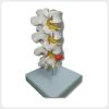 Lumbar spine model showing red herniated disc structure