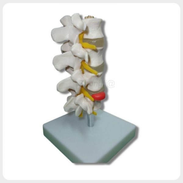 Lumbar spine model showing red herniated disc structure