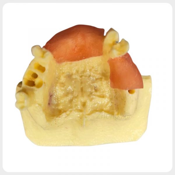 Maxillary Implant Case Training Model Maxillary implant case training model for dental education