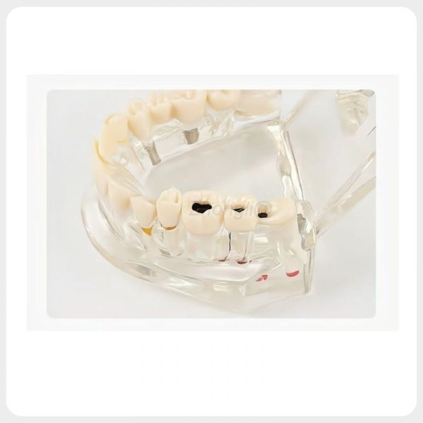 Dental Caries and Implant Demonstration Model Transparent dental restoration model showing caries and implant cases