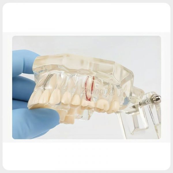 Dental Implant and Root Canal Demonstration Model Transparent dental implant model showing root canal and implant position