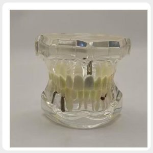 Transparent dental implant demonstration model with visible implant structure and removable restorations