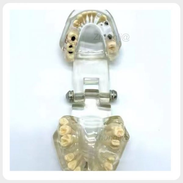 Transparent Dental Teaching Jaw Model Transparent dental jaw model with removable restorations and periodontal demonstration