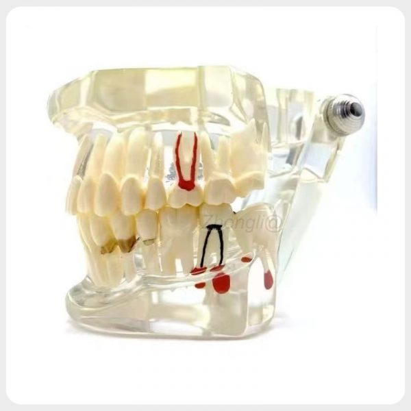 Transparent Periodontal Dental Demonstration Model Transparent periodontal and implant dental teaching model with visible lesions