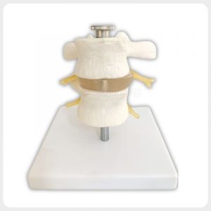 Detachable Two-Segment Lumbar Spine Model Detachable two-segment lumbar spine model with discs and nerve roots